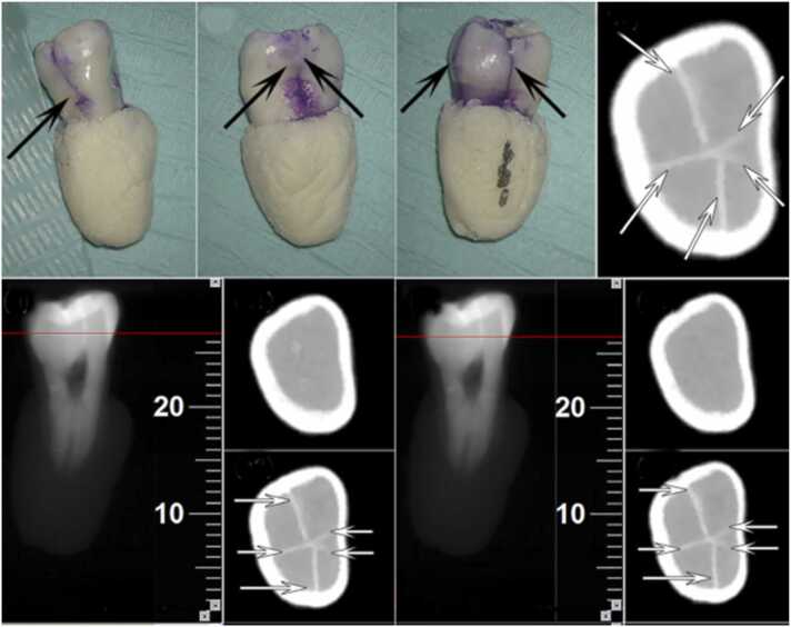 Diagnosis of cracked tooth: Clinical status and research progress