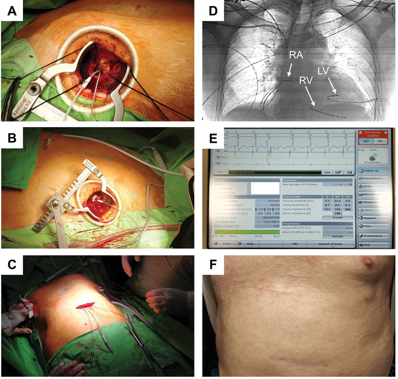 Concomitant Transatrial and Transapical CRT-D Lead Implantation in a Patient with Chest Burn Injury.