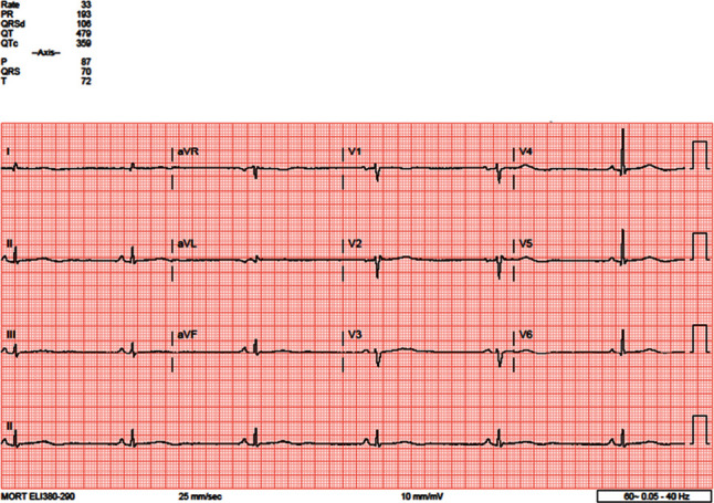 A Case of Profound Bradycardia in Endurance Athlete with Severe Anorexia Nervosa.