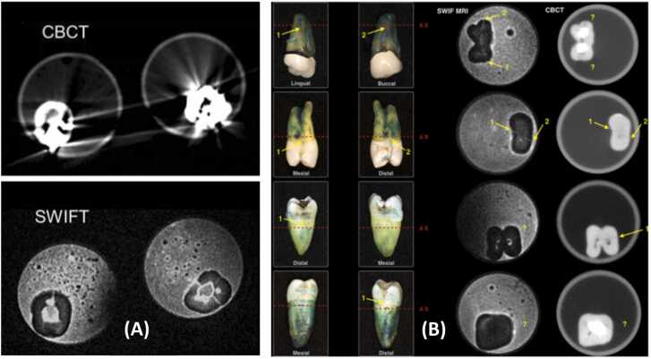 Diagnosis of cracked tooth: Clinical status and research progress