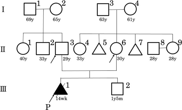 Novel missense COL2A1 variant in a fetus with achondrogenesis type II.