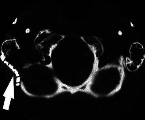 Something Got Your Tongue? A Unique Cause of Hypoglossal Nerve Palsy.