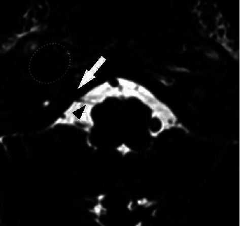 Something Got Your Tongue? A Unique Cause of Hypoglossal Nerve Palsy.