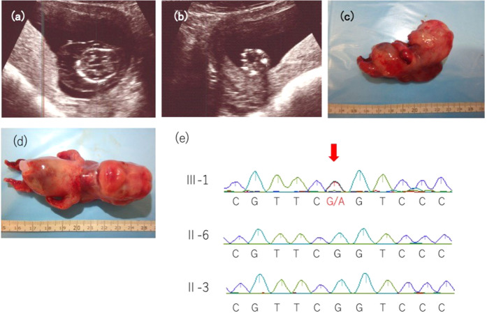 Novel missense COL2A1 variant in a fetus with achondrogenesis type II.