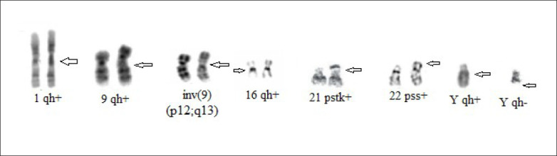 The pattern of chromosomal abnormalities in recurrent miscarriages: a single center retrospective study.