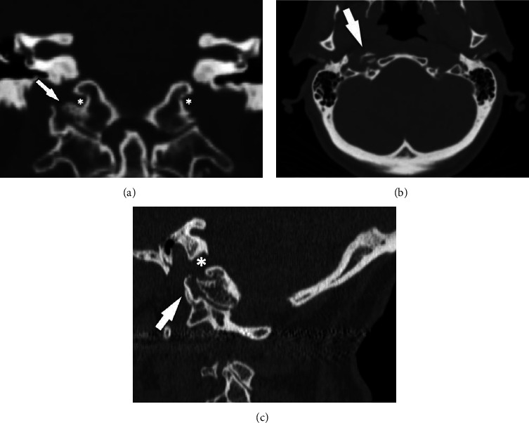 Something Got Your Tongue? A Unique Cause of Hypoglossal Nerve Palsy.