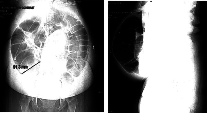 A Case of Acute Colonic Pseudo-Obstruction (Ogilvie's Syndrome) in a Nonsurgical Patient with Plasma Cell Leukemia.