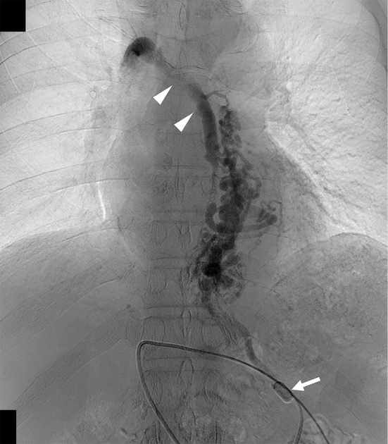 A Case of Esophagojejunal Variceal Rupture after Total Gastrectomy and Esophagojejunostomy Successfully Treated with Percutaneous Transhepatic Obliteration under Dual-balloon Occlusion of Feeding and Draining Veins.