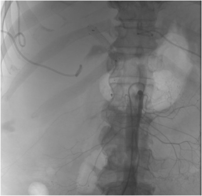 Portal vein embolization in the treatment of portal vein bleeding after percutaneous transhepatic biliary drainage: A case report and literature review