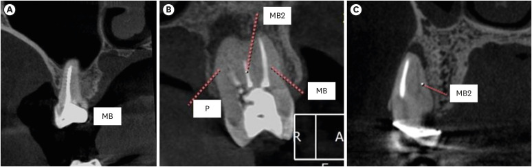 Apical periodontitis in mesiobuccal roots of maxillary molars: influence of anatomy and quality of root canal treatment, a CBCT study.