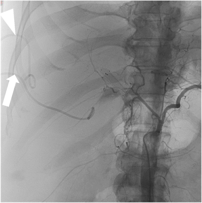 Portal vein embolization in the treatment of portal vein bleeding after percutaneous transhepatic biliary drainage: A case report and literature review