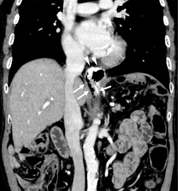 A Case of Esophagojejunal Variceal Rupture after Total Gastrectomy and Esophagojejunostomy Successfully Treated with Percutaneous Transhepatic Obliteration under Dual-balloon Occlusion of Feeding and Draining Veins.