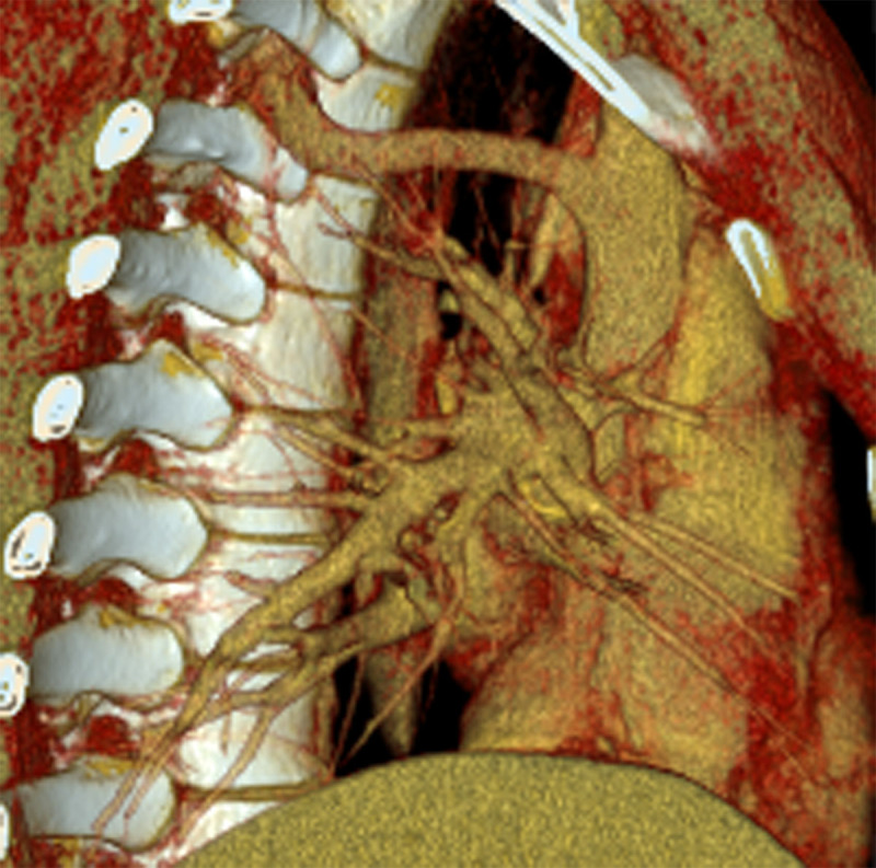 Intraspinal Azygos Vein.