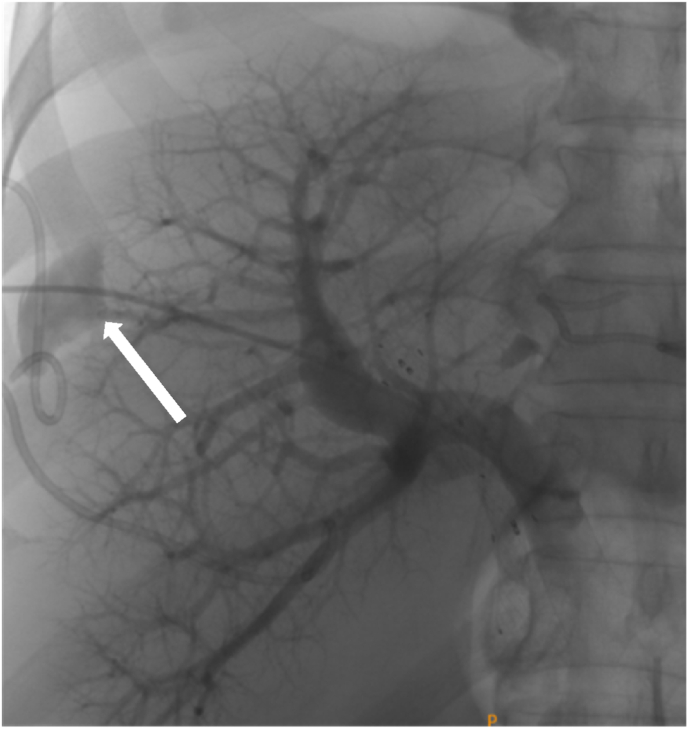 Portal vein embolization in the treatment of portal vein bleeding after percutaneous transhepatic biliary drainage: A case report and literature review