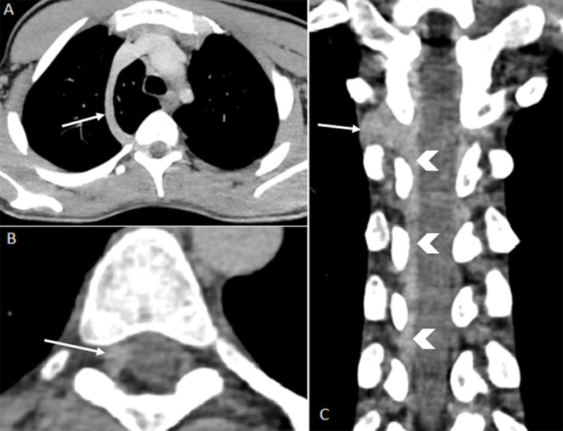 Intraspinal Azygos Vein.