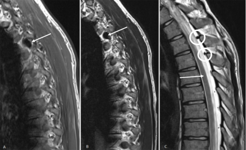 Intraspinal Azygos Vein.