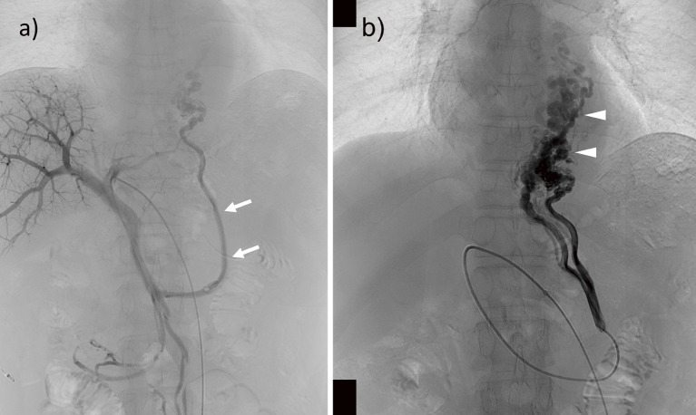 A Case of Esophagojejunal Variceal Rupture after Total Gastrectomy and Esophagojejunostomy Successfully Treated with Percutaneous Transhepatic Obliteration under Dual-balloon Occlusion of Feeding and Draining Veins.