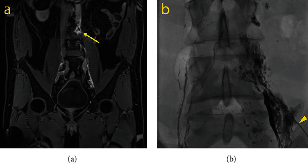 Intranodal Ultrasound-Guided Percutaneous Methylene Blue Injection for the Identification of Leakage Point during Laparoscopic Repair of Refractory Chylous Ascites after Laparoscopic Lymphadenectomy for Kidney Cancer.