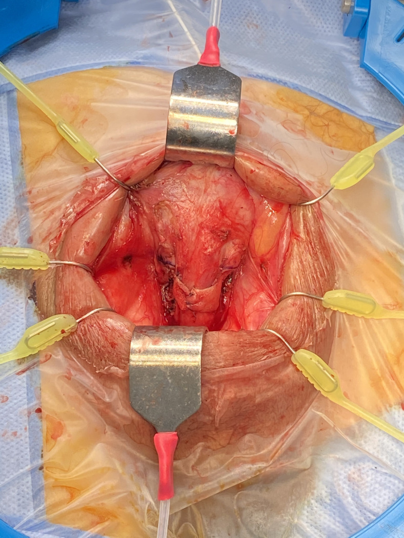 Artificial Urinary Sphincter in a High-Risk Urethra: Transcorporal Gullwing Modification Description of the Technique.