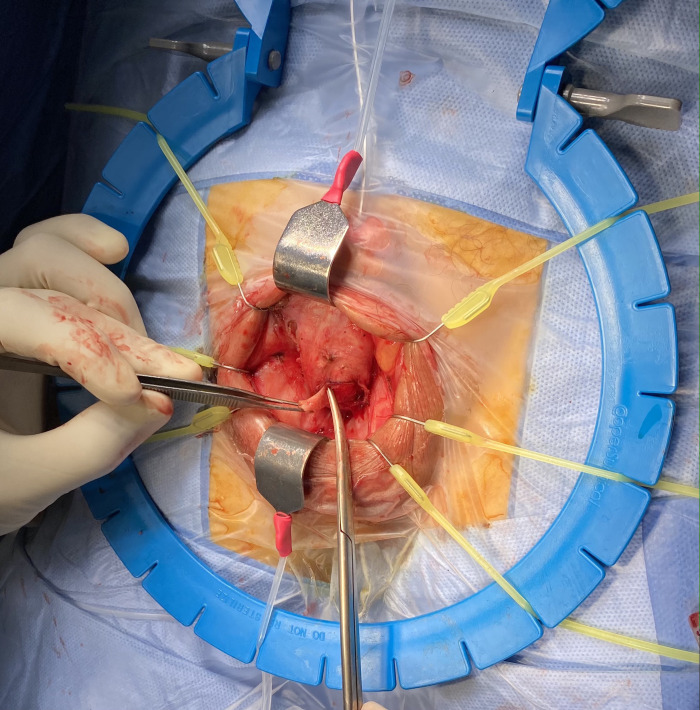 Artificial Urinary Sphincter in a High-Risk Urethra: Transcorporal Gullwing Modification Description of the Technique.