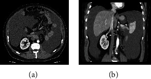 Intranodal Ultrasound-Guided Percutaneous Methylene Blue Injection for the Identification of Leakage Point during Laparoscopic Repair of Refractory Chylous Ascites after Laparoscopic Lymphadenectomy for Kidney Cancer.