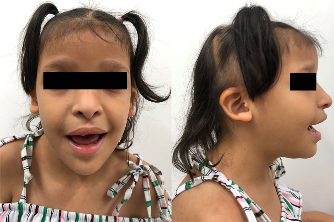 Mowat-Wilson Syndrome as a Differential Diagnosis in Patients with Congenital Heart Defects and Dysmorphic Facies.