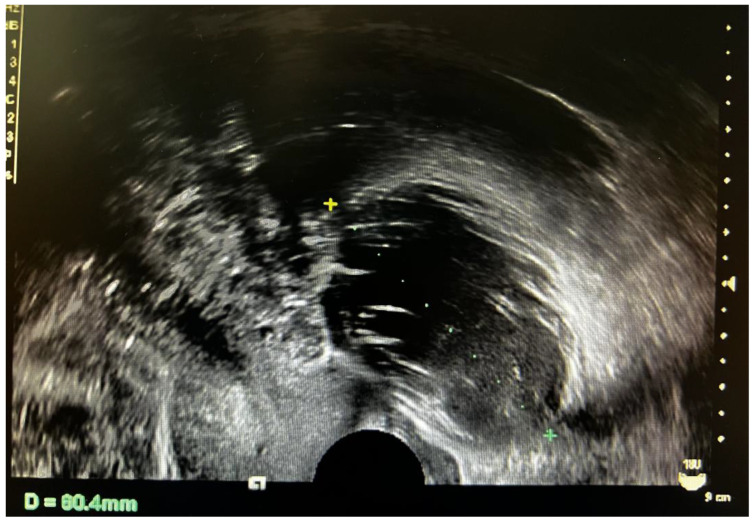 Strumal Carcinoid Tumor of the Ovary: Report of Rare Occurrence with Review of Literature.