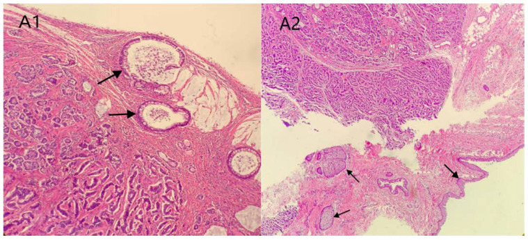 Strumal Carcinoid Tumor of the Ovary: Report of Rare Occurrence with Review of Literature.