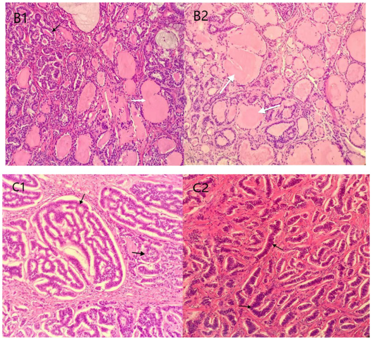 Strumal Carcinoid Tumor of the Ovary: Report of Rare Occurrence with Review of Literature.