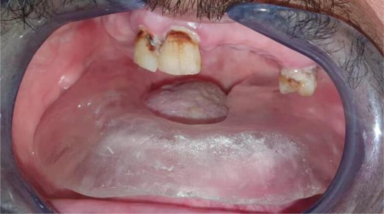 Protective and positioning devices in maxillofacial prosthodontics and radiotherapy: Overview