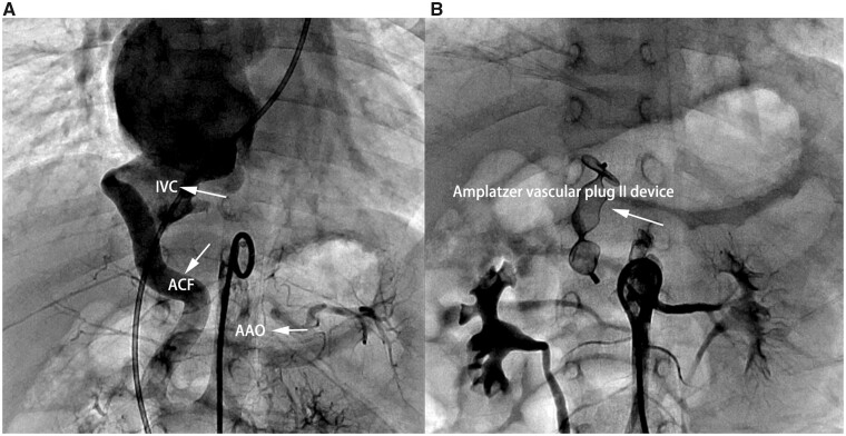 Congenital aortocaval fistula combined with patent ductus arteriosus in an infant: a case report.