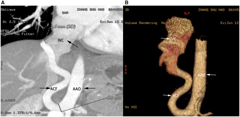 Congenital aortocaval fistula combined with patent ductus arteriosus in an infant: a case report.