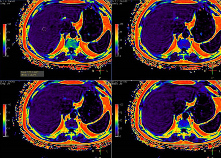 Clinical Spectrum of Nonalcoholic Fatty Liver Disease in Patients with Chronic Obstructive Pulmonary Disease.