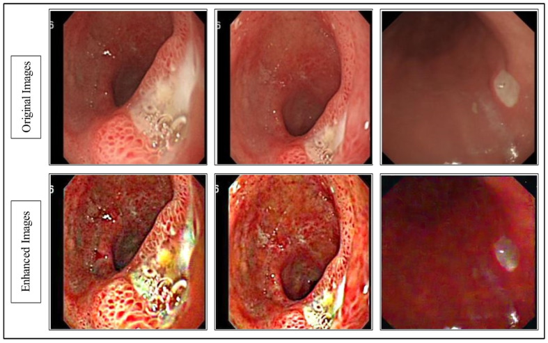 GestroNet: A Framework of Saliency Estimation and Optimal Deep Learning Features Based Gastrointestinal Diseases Detection and Classification.