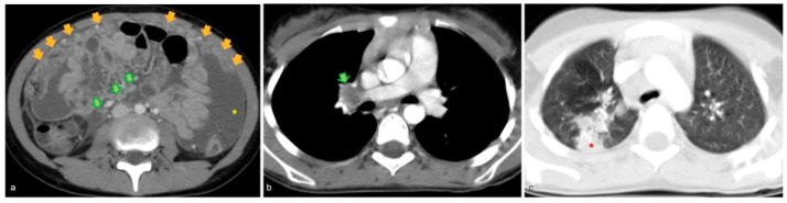 The Omental Cake Sign in Pediatric Tuberculosis.