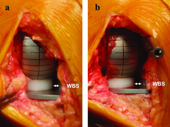 Intramedullary rod insertion places the femoral component more laterally during Oxford medial unicompartmental knee arthroplasty.