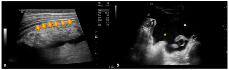 The Omental Cake Sign in Pediatric Tuberculosis.