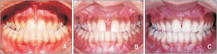 Effectiveness of low-level laser therapy in facilitating maxillary expansion using bone-borne hyrax expander: A randomized clinical trial.