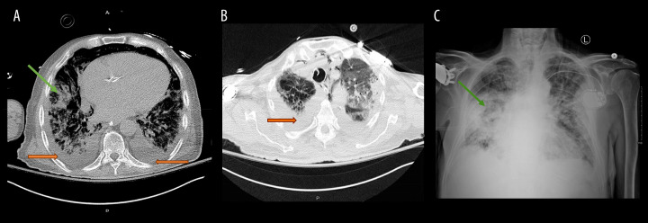Rare Case of Persistently Depressed T Lymphocyte Subsets After SARS-CoV-2 Infection.