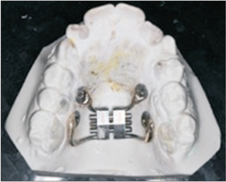 Effectiveness of low-level laser therapy in facilitating maxillary expansion using bone-borne hyrax expander: A randomized clinical trial.