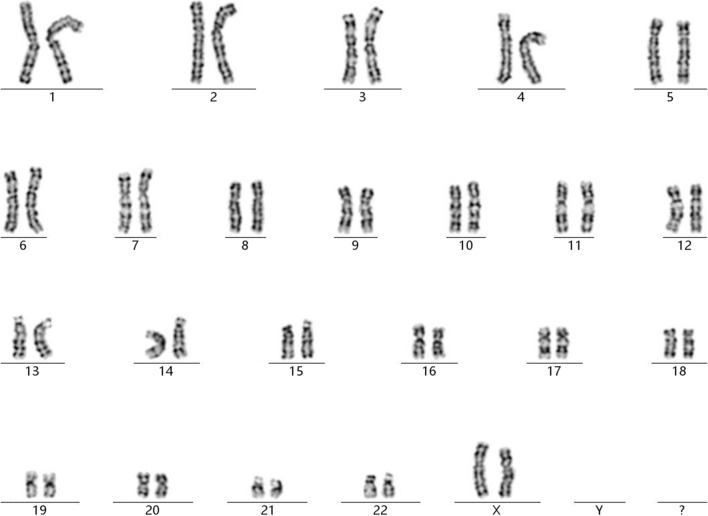 Prenatal diagnosis and genetic counseling of an inherited Xq24q25 deletion associated with normal phenotype.