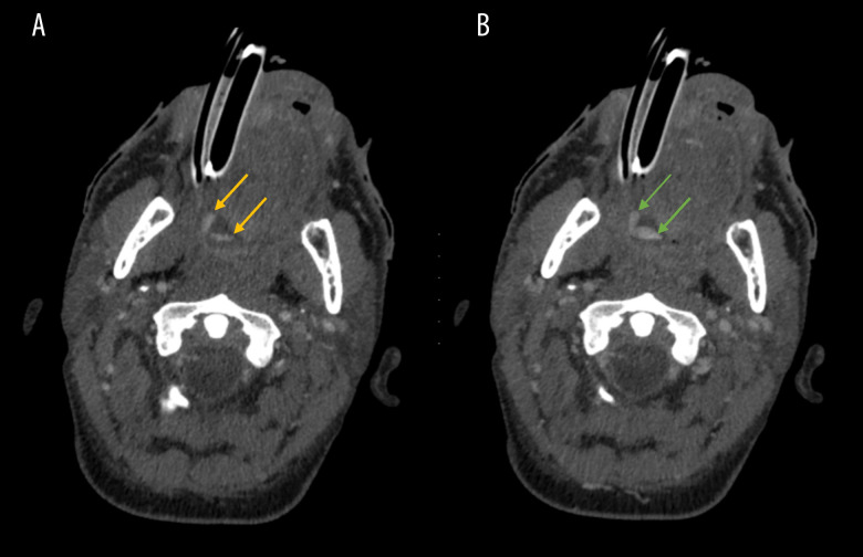 Spontaneous Oropharyngeal Hemorrhage Complicated by Cirrhosis, Resulting in Hemorrhagic Shock.
