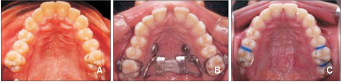 Effectiveness of low-level laser therapy in facilitating maxillary expansion using bone-borne hyrax expander: A randomized clinical trial.