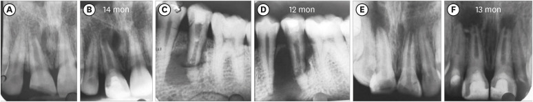 Evaluation of blood clot, platelet-rich plasma, and platelet-rich fibrin-mediated regenerative endodontic procedures in teeth with periapical pathology: a CBCT study.