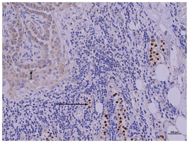 Papillary Thyroid Cancer Metastases to the Parathyroid Gland.