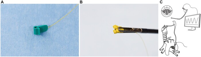 Continuous vagal intraoperative neuromonitoring during video-assisted thoracoscopic surgery for left lung cancer: its efficacy in preventing permanent vocal cord paralysis.