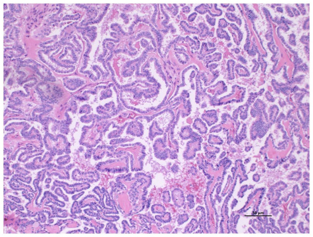 Papillary Thyroid Cancer Metastases to the Parathyroid Gland.