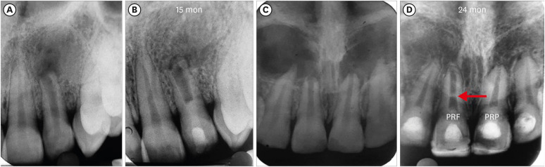 Evaluation of blood clot, platelet-rich plasma, and platelet-rich fibrin-mediated regenerative endodontic procedures in teeth with periapical pathology: a CBCT study.