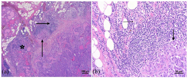 Papillary Thyroid Cancer Metastases to the Parathyroid Gland.