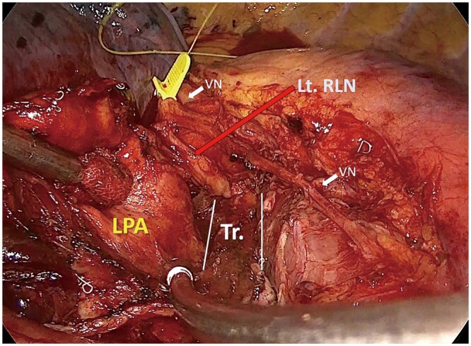 Continuous vagal intraoperative neuromonitoring during video-assisted thoracoscopic surgery for left lung cancer: its efficacy in preventing permanent vocal cord paralysis.